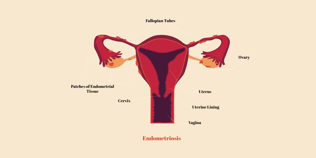 My goddam uterus